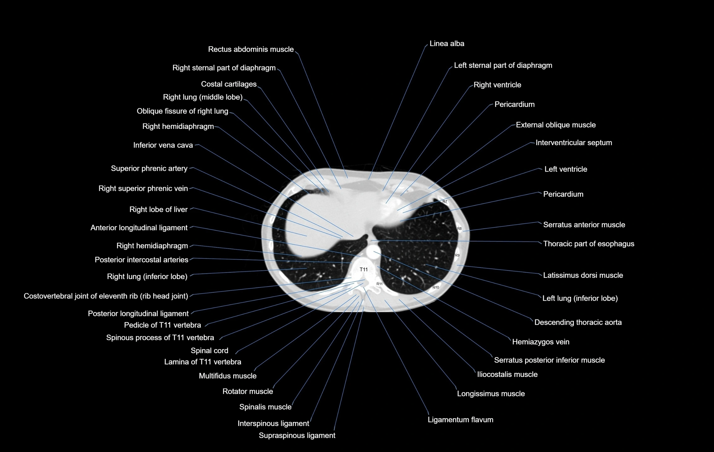 CT chest (thorax) labelled axial cross sectional anatomy radiology image-00099.webp